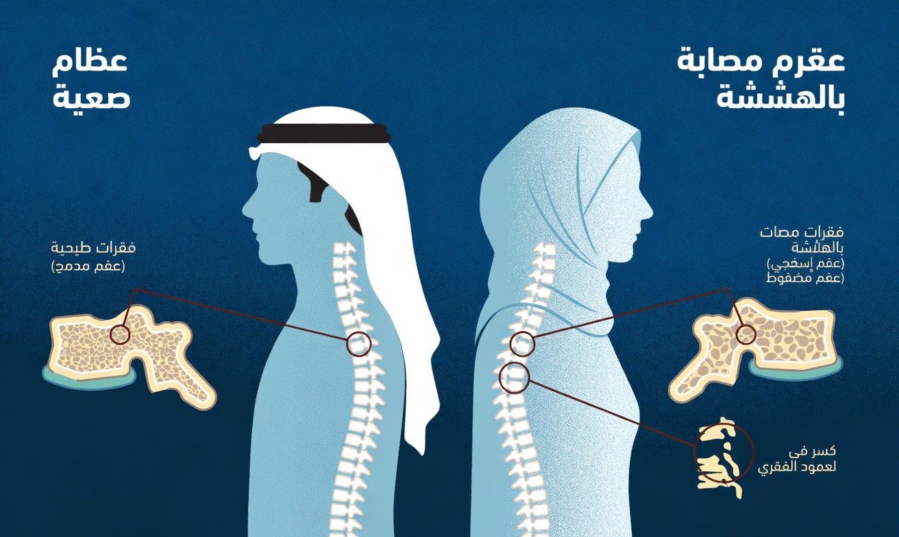 العمود الفقري الصحي مقابل هشاشة العظام: عادات يومية بسيطة لدعم عظام قوية ووضعية أفضل