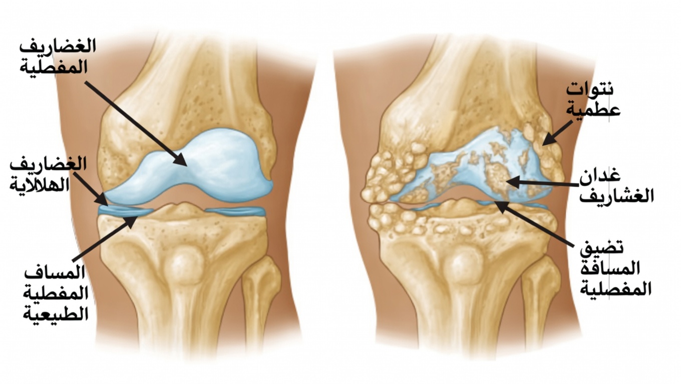 ما العلاجات الجديدة المتاحة لمرضى التهاب المفاصل الروماتويدي الساعين إلى أملٍ لأيامٍ أفضل قادمة؟