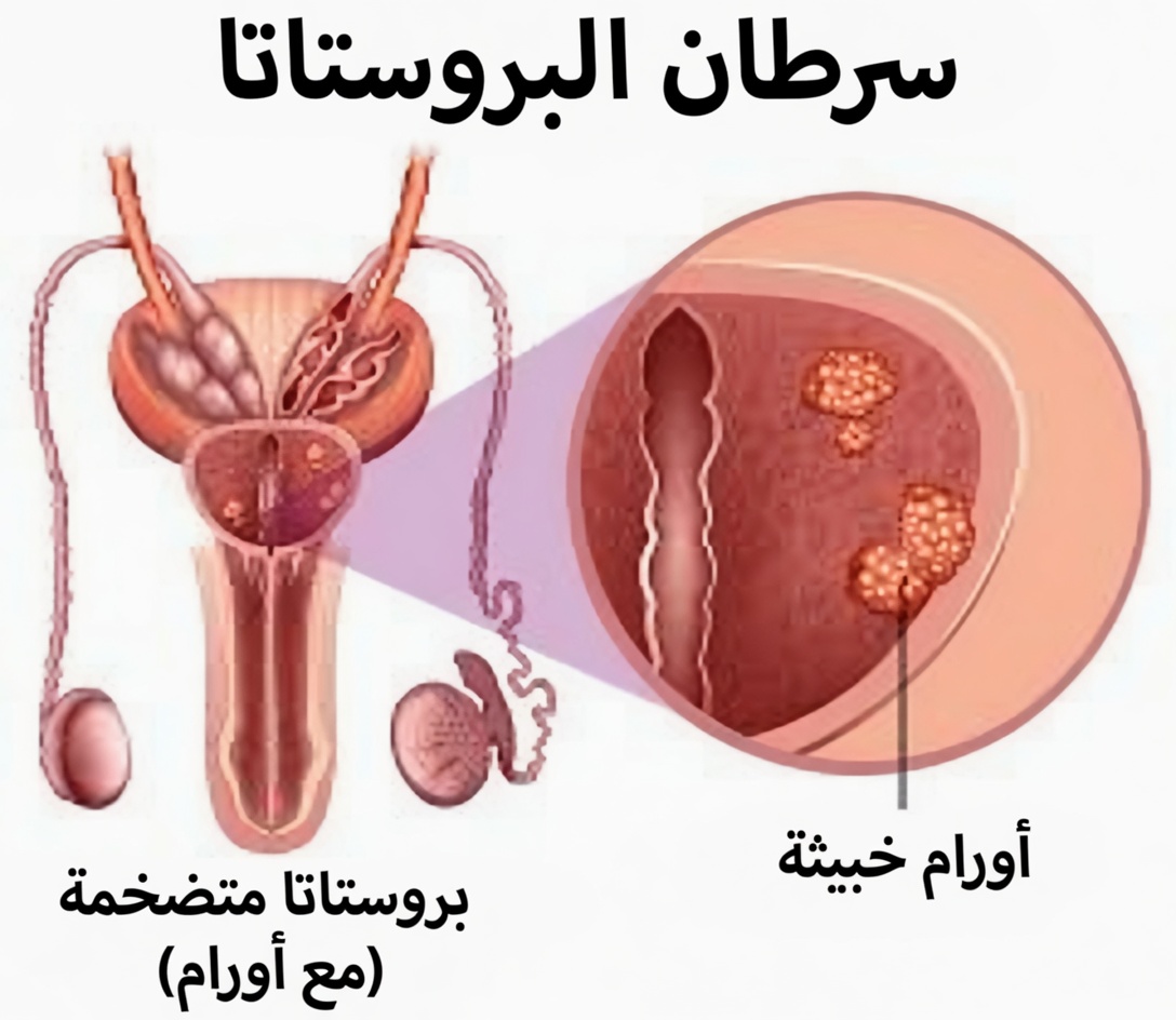 كيف يمكن للثوم أن يدعم صحة البروستاتا طبيعيًا مع تقدمك في العمر – عادة يومية بسيطة لراحة أكبر