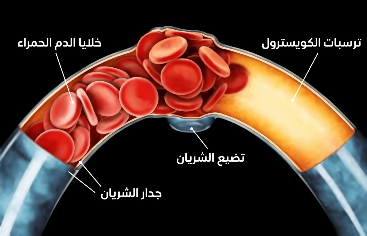 يحذر الأطباء: 10 علامات صامتة على انسداد شرايين الساق