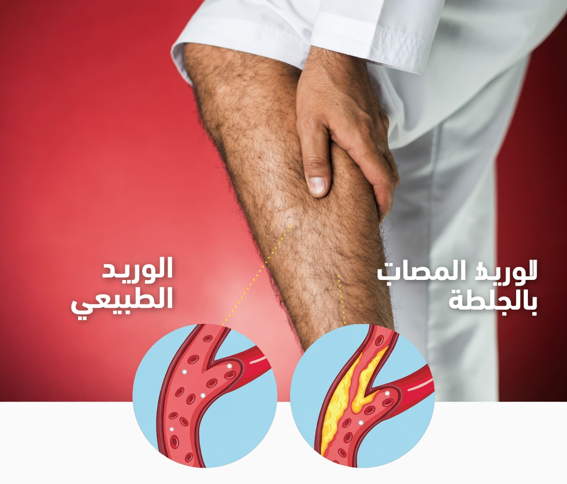 يحذر الأطباء: 10 علامات صامتة على انسداد شرايين الساق