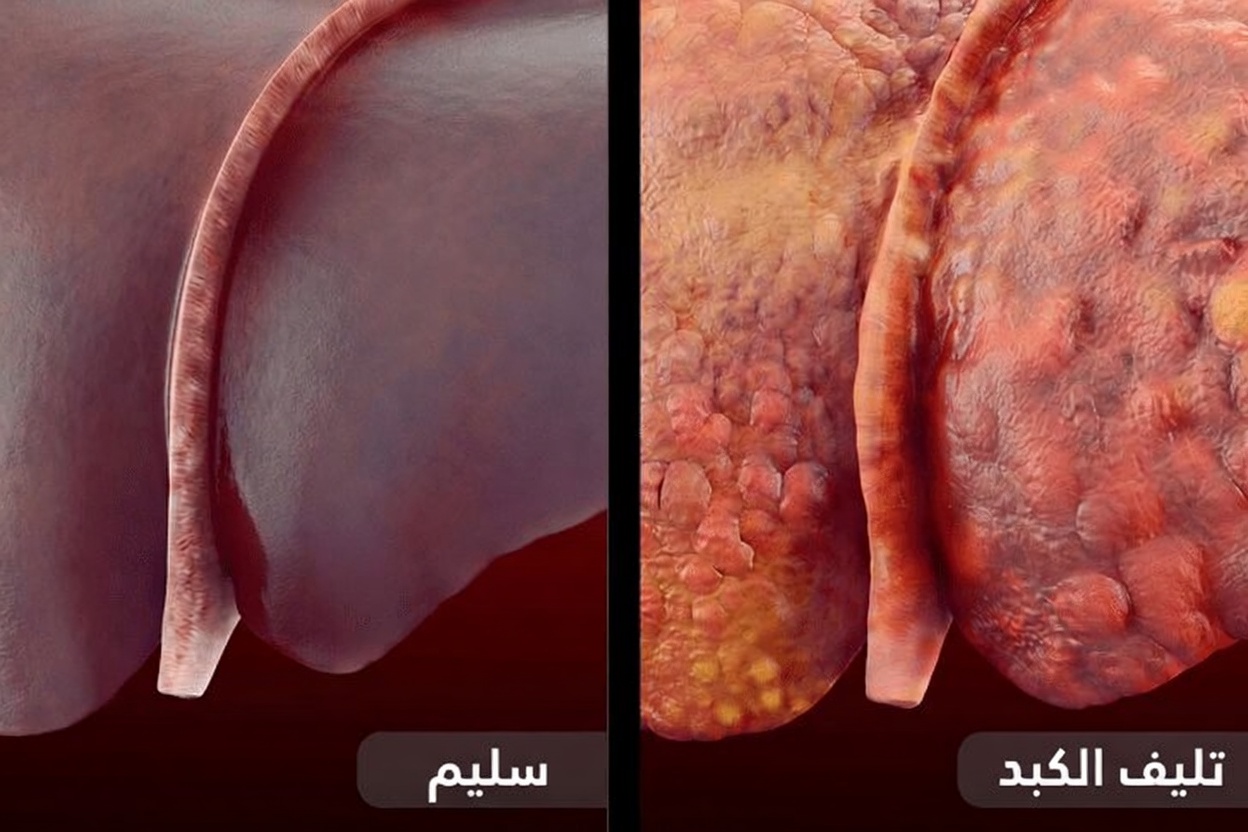 التهديد الصامت المختبئ في كبدك: ٨ علامات تحذيرية لمرض الكبد الدهني يجب التعرّف عليها