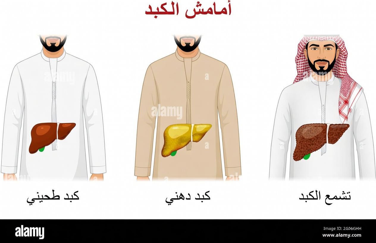 التهديد الصامت المختبئ في كبدك: ٨ علامات تحذيرية لمرض الكبد الدهني يجب التعرّف عليها