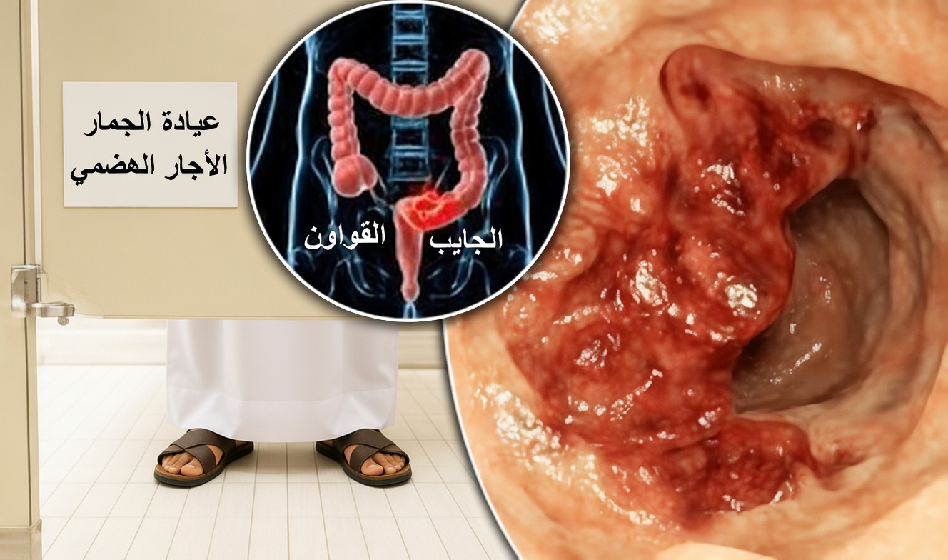 10 علامات تحذيرية خفية لسرطان القولون ربما تتجاهلها حتى لو أغفل الأطباء العلامة رقم 3