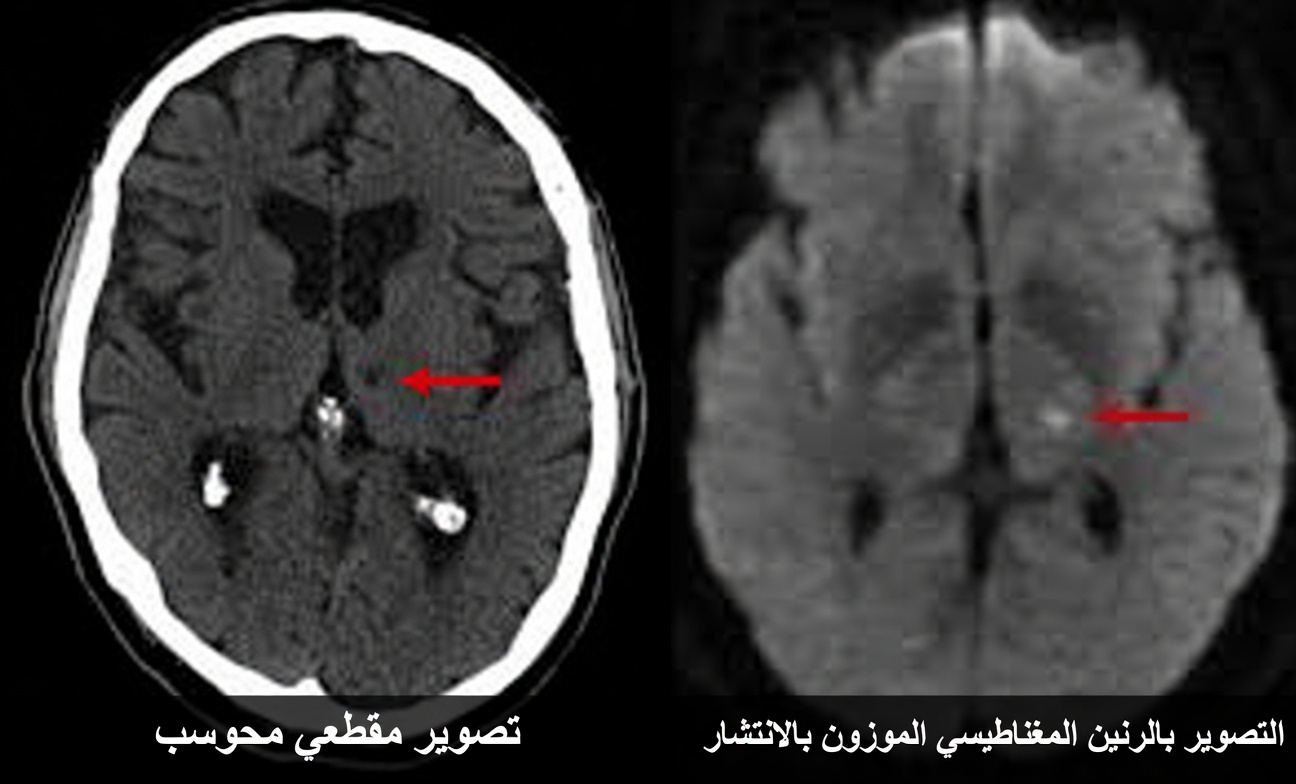 ٧ علامات تحذيرية للسكتة الدماغية الجوبية لدى من تجاوزوا الستين يتجاهلها الجميع (خصوصًا رقم ٤)