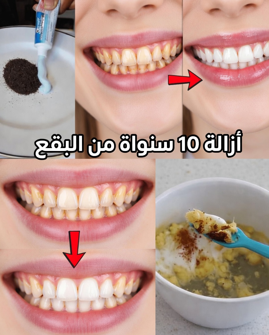في دقيقتين فقط، أزل 10 سنوات من تصبغات الأسنان – المبيض الطبيعي الذي يعمل فعلاً