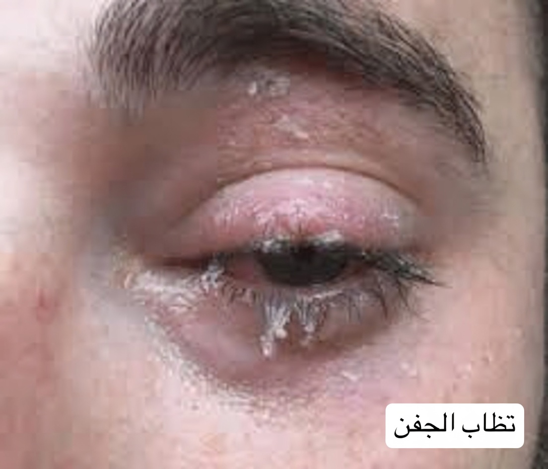 هل عين طفلك الصغير ملتصقة بإفرازات صفراء لزجة؟ طرق آمنة لتنظيفها في المنزل