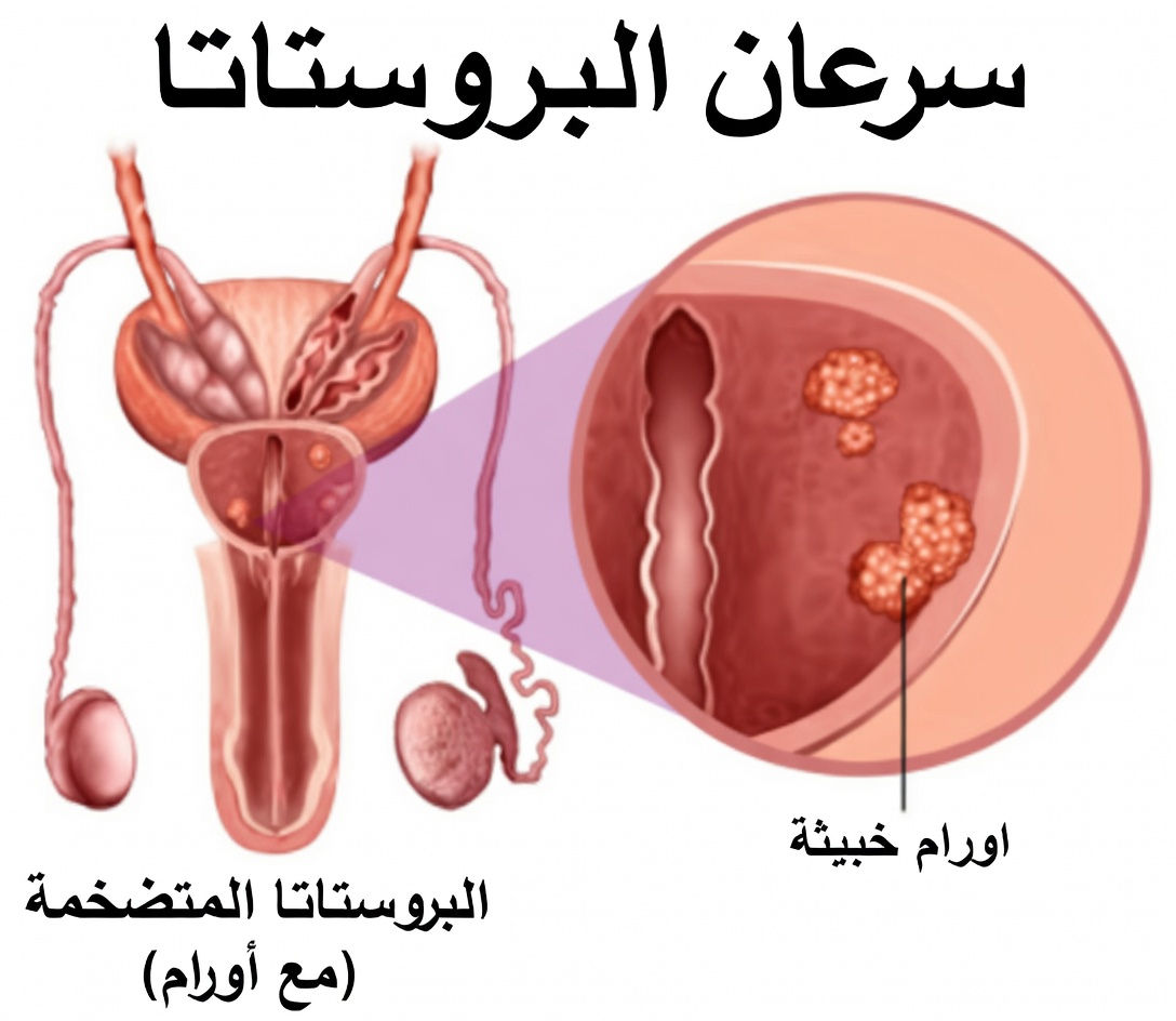 سيجعل مثانتك وبروستاتك كأنهما جديدتين! وصفة الجد