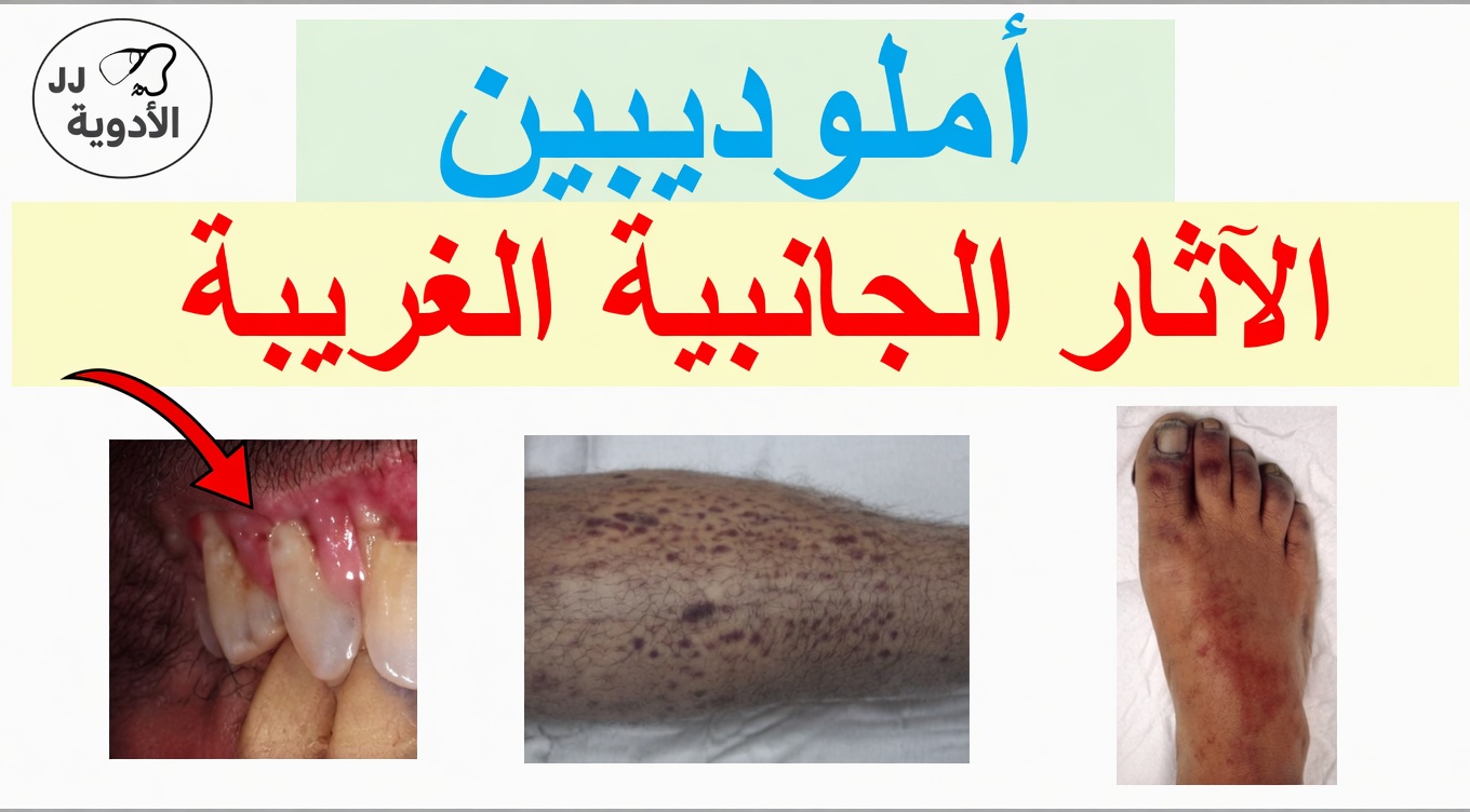 الآثار الجانبية لأملوديبين: ما الذي تعنيه فعلاً وخطوات بسيطة قد تساعد في تقليل الانزعاج