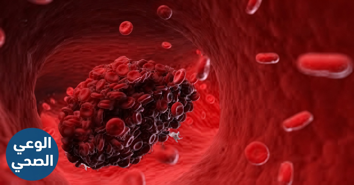 هل يمكن للفيتامينات إذابة جلطات الدم في الساق؟ الحقيقة والمخاطر وما يساعد فعلاً