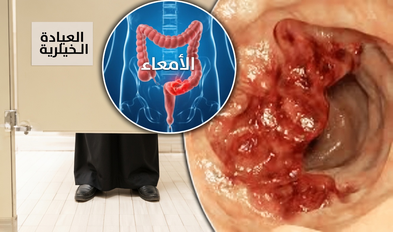 10 علامات تحذيرية صامتة لسرطان القولون ربما تتجاهلها (حتى الأطباء أحيانًا يغفلون عن رقم 3)