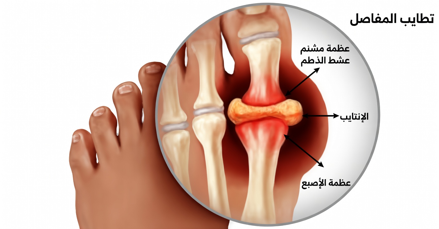 أسهل وأسرع الطرق للمساعدة في التخلص من بلورات حمض اليوريك من جسمك للوقاية من النقرس وآلام المفاصل