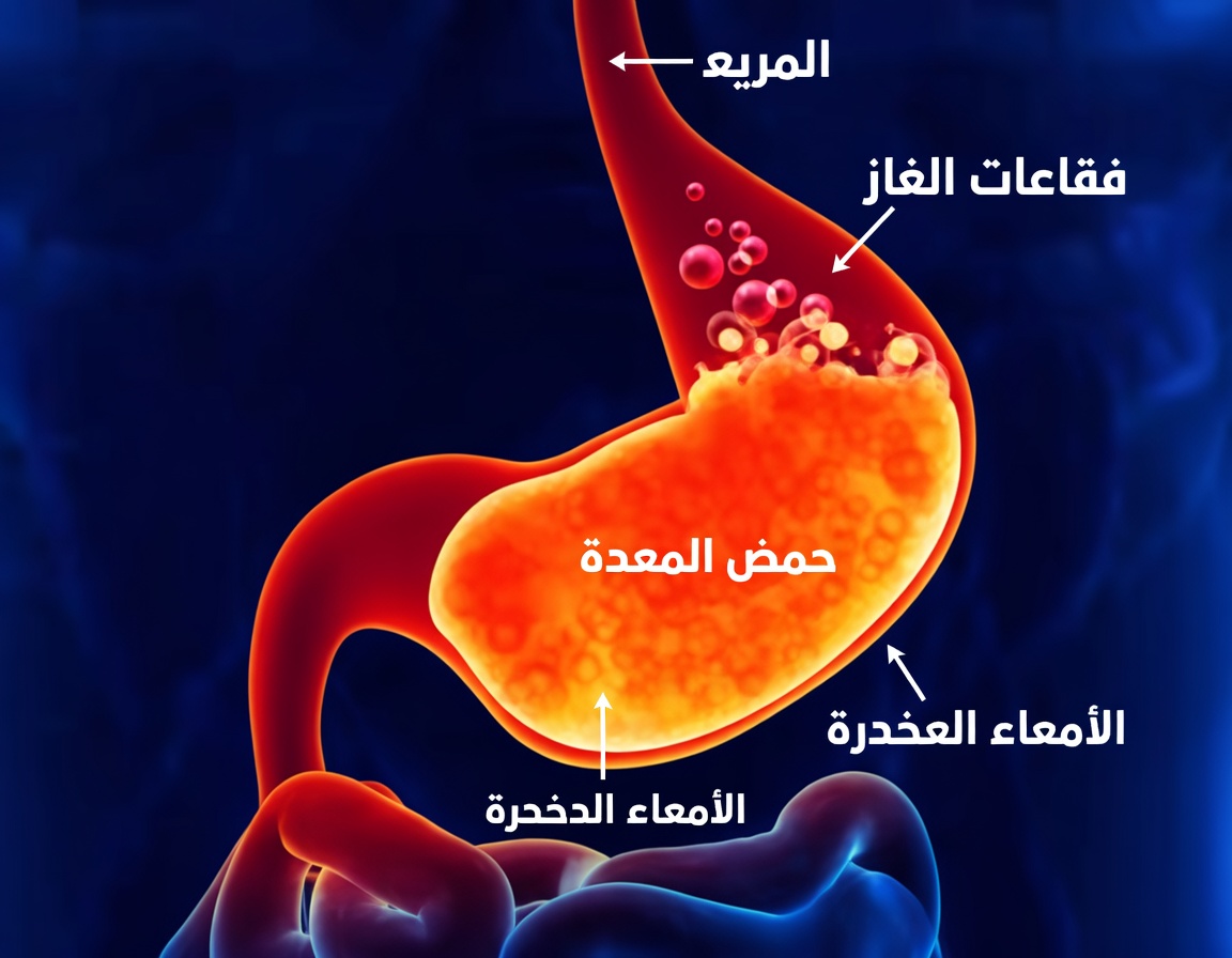 وداعًا لحرقة المعدة والانتفاخ: اكتشف كيفية القضاء على البكتيريا المسببة لهما!