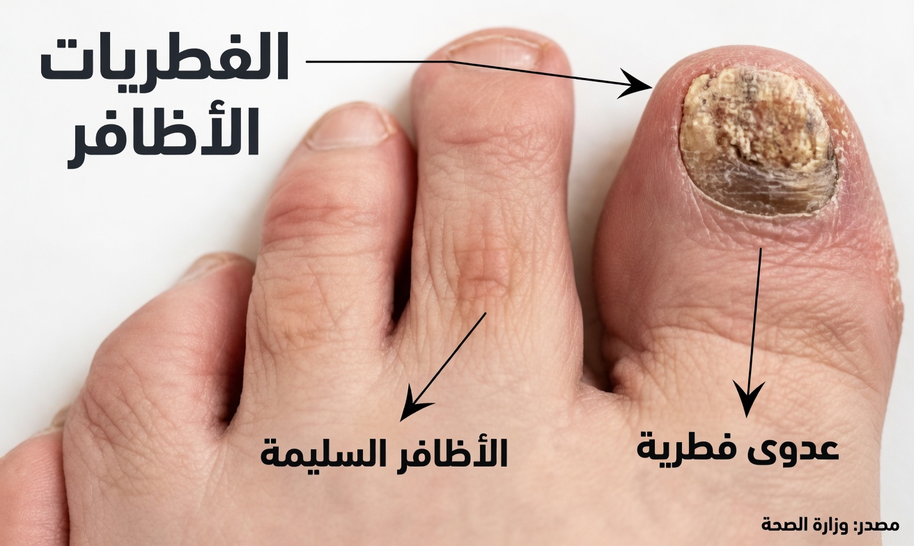 سيختفي الفطر إلى الأبد بموزة وفازلين! طبيب يشارك سره