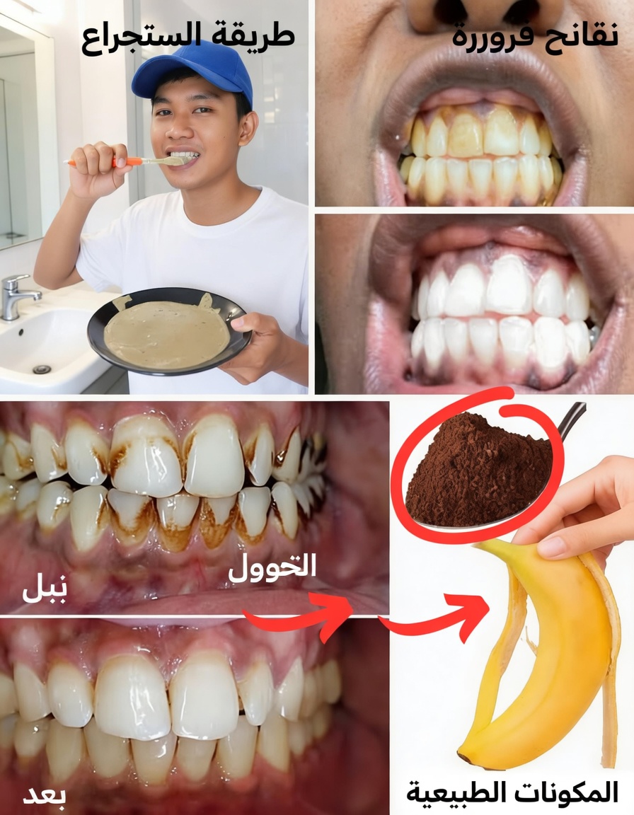 كيفية تبييض الأسنان الصفراء طبيعيًا في المنزل: استكشاف طريقة قشر الموز والزنجبيل والليمون