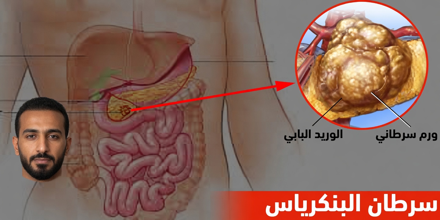 10 علامات تحذيرية خفية لسرطان البنكرياس يهمس بها جسدك الآن