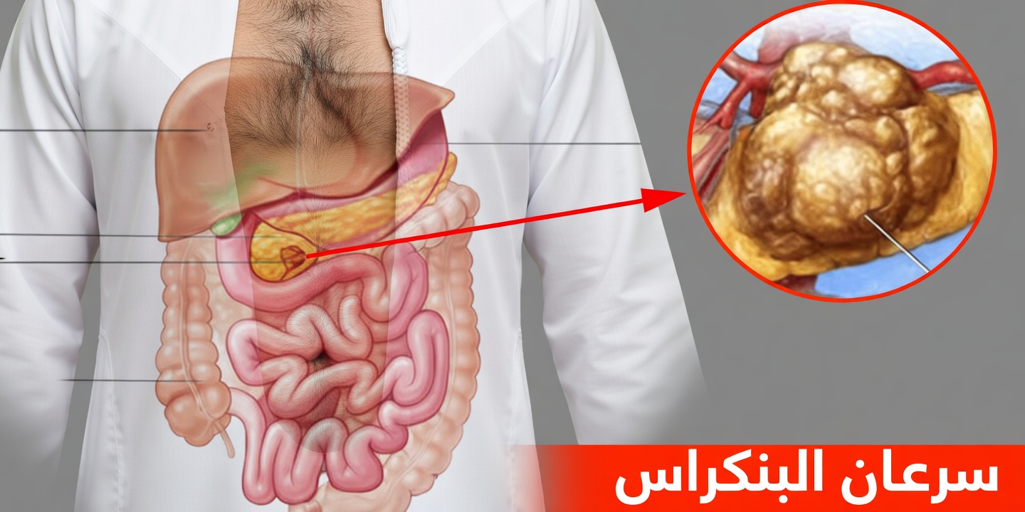 سرطان البنكرياس: عَرَضان ظهرا متأخرَين جدًا