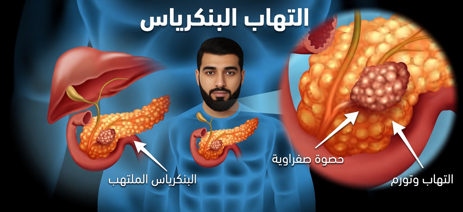 سرطان البنكرياس: عَرَضان ظهرا متأخرَين جدًا