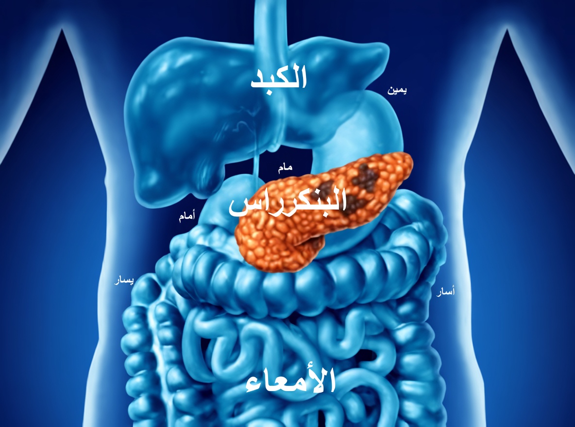 سرطان البنكرياس: عَرَضان ظهرا متأخرَين جدًا