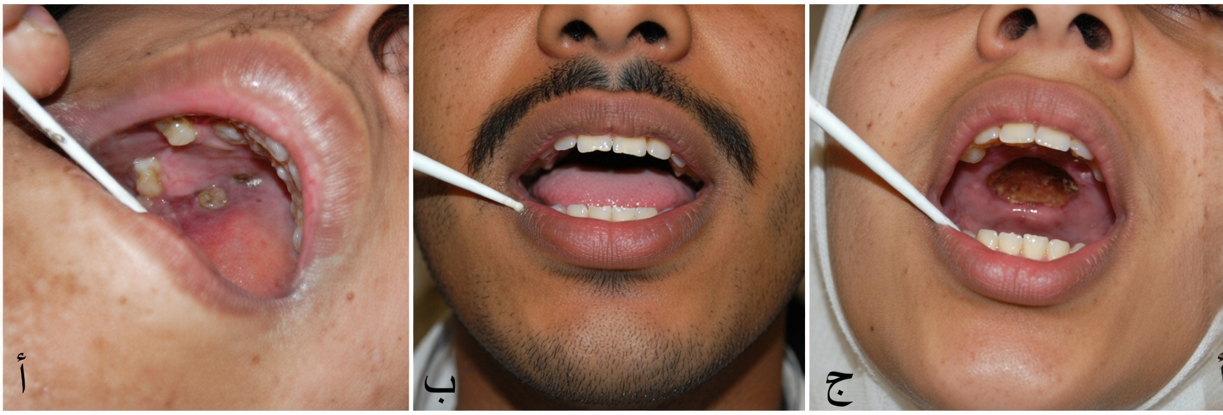 امرأة تُعاني عدوى فطرية في الأنف مرتبطة بعادة يومية