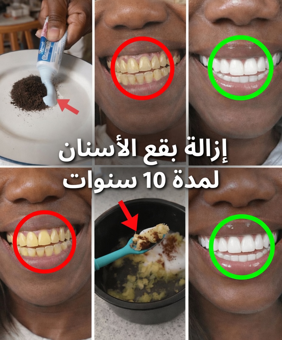 في دقيقتين فقط، أزل 10 سنوات من بقع الأسنان – المبيّض الطبيعي الذي يعمل فعلاً