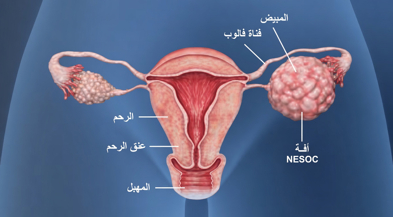 8 علامات صامتة لسرطان المبيض يجب على كل امرأة معرفتها (ولماذا الوعي المبكر ينقذ الأرواح)