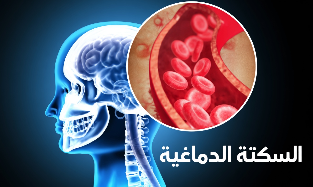 7 علامات تحذيرية للسكتة الدماغية الجُوَيَّفِيَّة لدى الأشخاص فوق سن الستين يتجاهلها الجميع، خصوصًا العلامة رقم 4