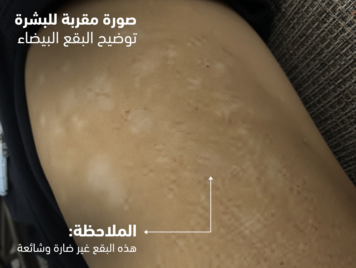 هل لاحظتَ بقعًا بيضاء صغيرة على ذراعيك أو ساقيك… ولا تعرف ما هي؟