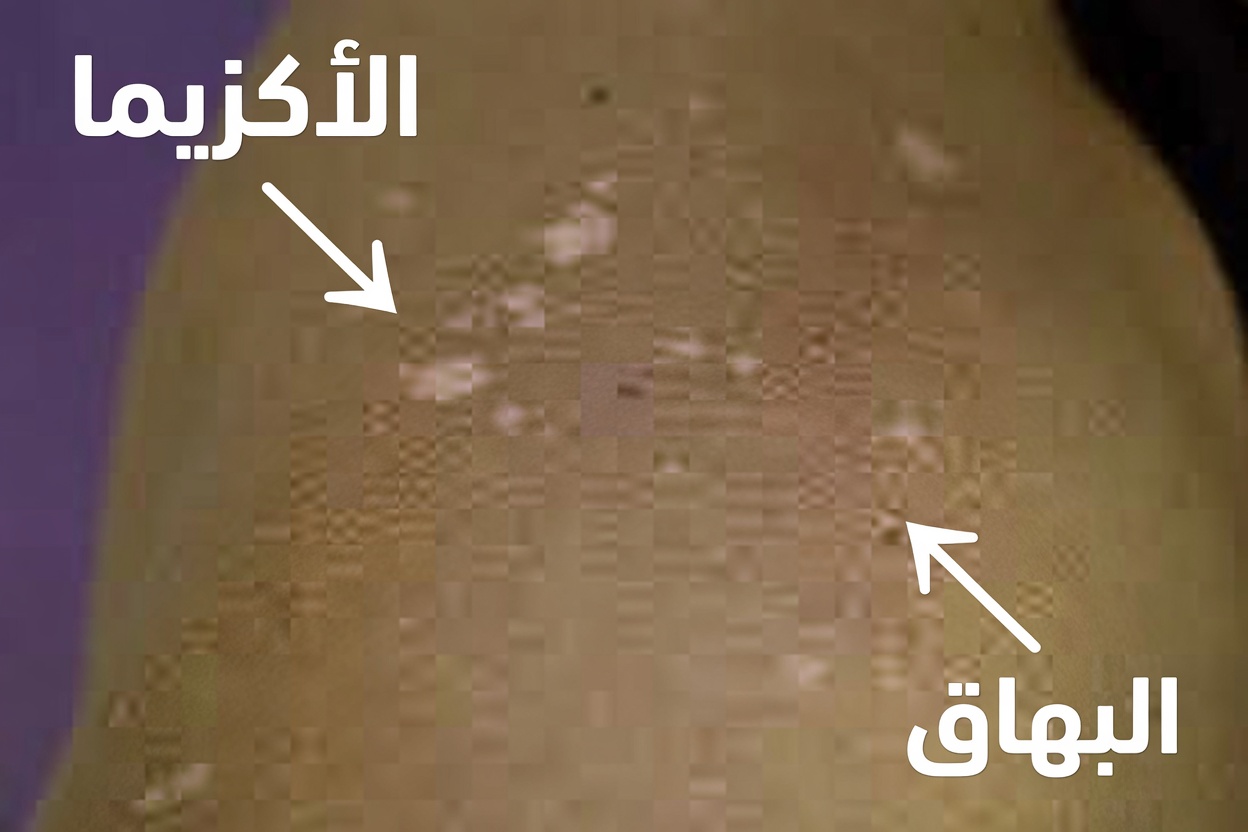 هل لاحظتَ بقعًا بيضاء صغيرة على ذراعيك أو ساقيك… ولا تعرف ما هي؟