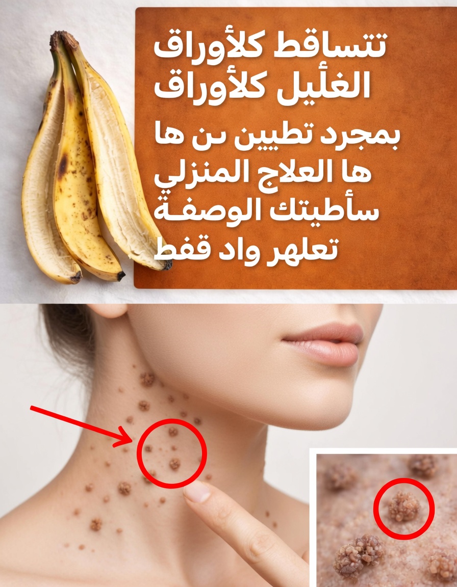 هل تساعد قشور الموز حقًا في إزالة الثآليل؟ شرح علاج منزلي بسيط