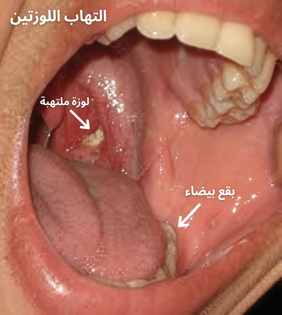 حصوات اللوزتين: اكتشف ماهيّتها، وكيف تظهر، وكيف تتخلص منها نهائيًا