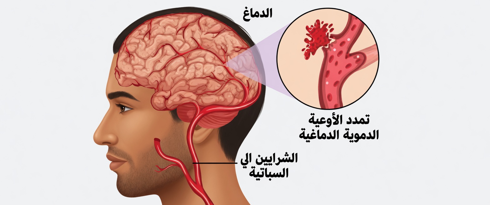 ٨ علامات تحذيرية للسكتة الدماغية قد تظهر قبل شهر، و٩ نصائح للوقاية منها