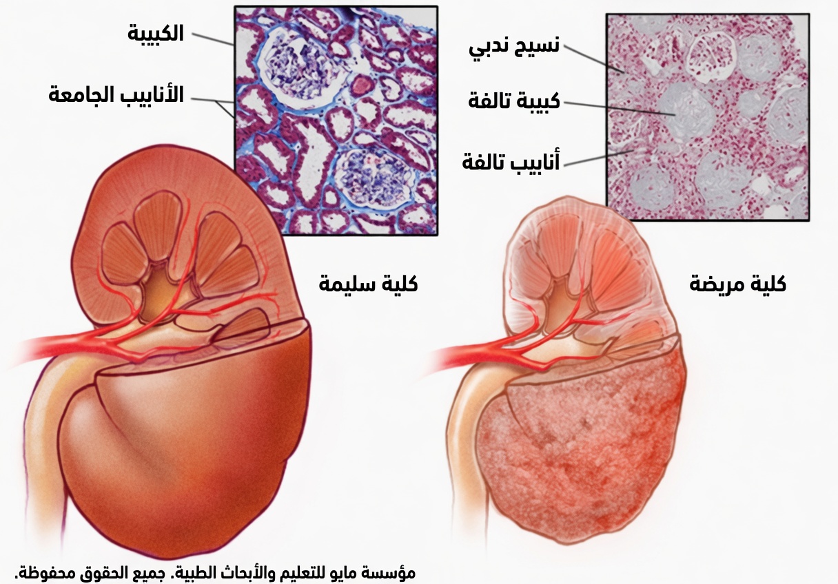 هل يتسرّب البروتين في بولك؟ جرّب هذه الأطعمة العلاجية السبعة لدعم صحة الكلى طبيعيًا