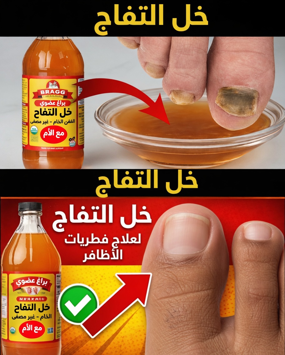 علاج فطريات أظافر القدم باستخدام خل التفاح: علاج سريع ورخيص