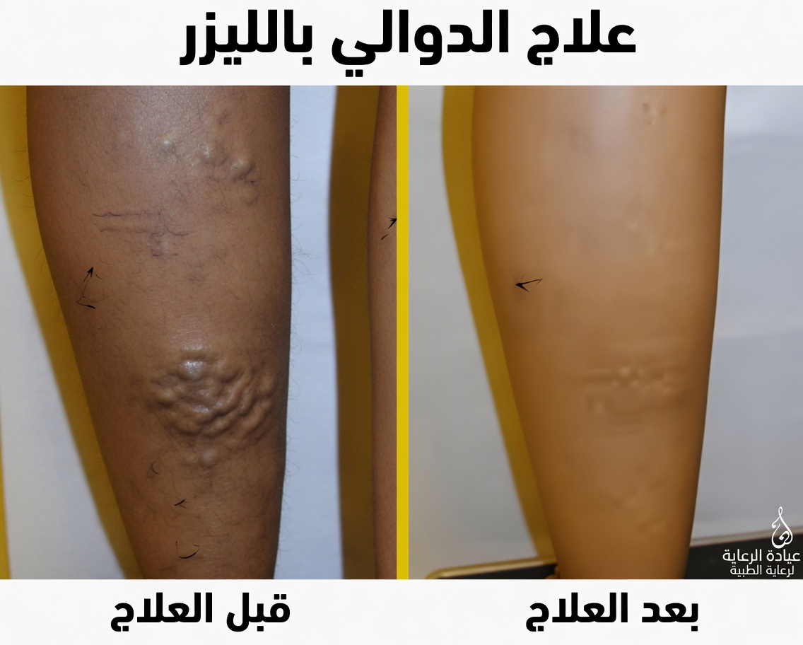 علاج طبيعي من الجدة لدوالي الساقين