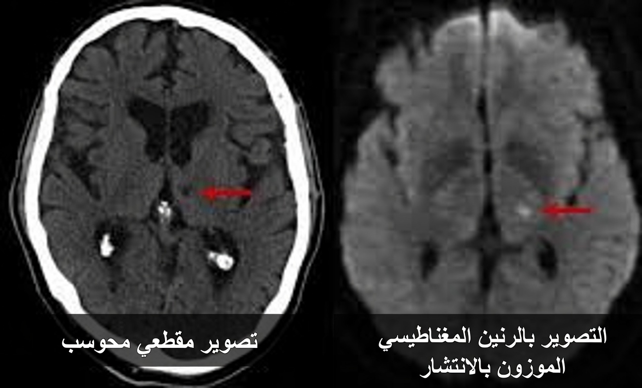 7 علامات تحذيرية للسكتة الدماغية الجوبية يتجاهلها كثيرون لدى الأشخاص فوق سن 60 (معظم الناس يفوتهم رقم 4)