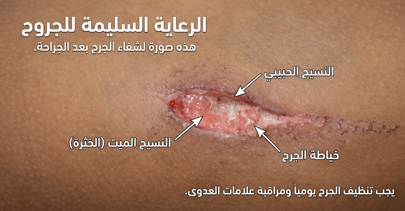 علامات تدل على أن مستوى السكر في الدم مرتفع جدًا... شاهد المزيد