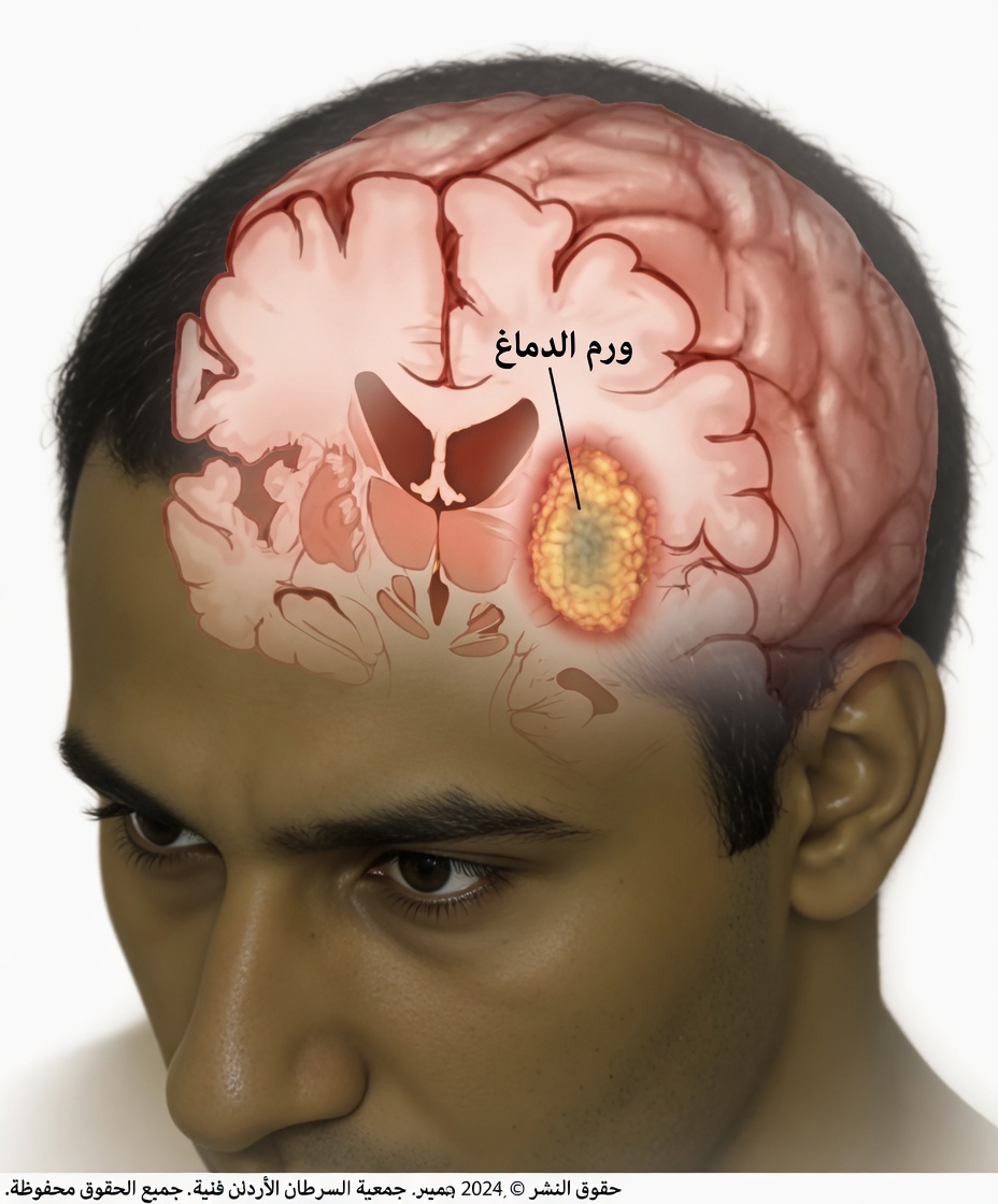 لا تفوّت هذه العلامات الثماني المبكرة لورم الدماغ – قد تنقذ حياتك!