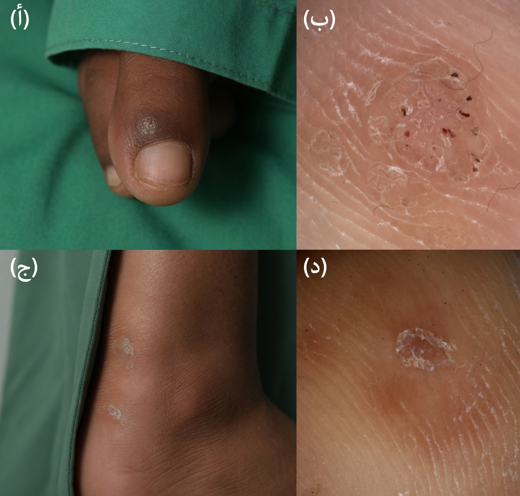 هل يمكن لقشر الموز حقًا أن يساعد في علاج الثآليل؟ نظرة لطيفة على هذا العلاج المنزلي البسيط