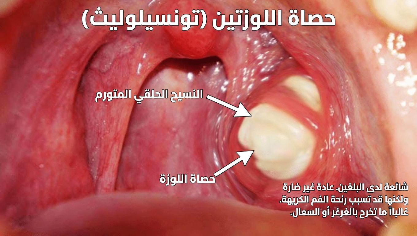 فهم حصوات اللوزتين: ما تحتاج إلى معرفته وكيفية التعامل معها
