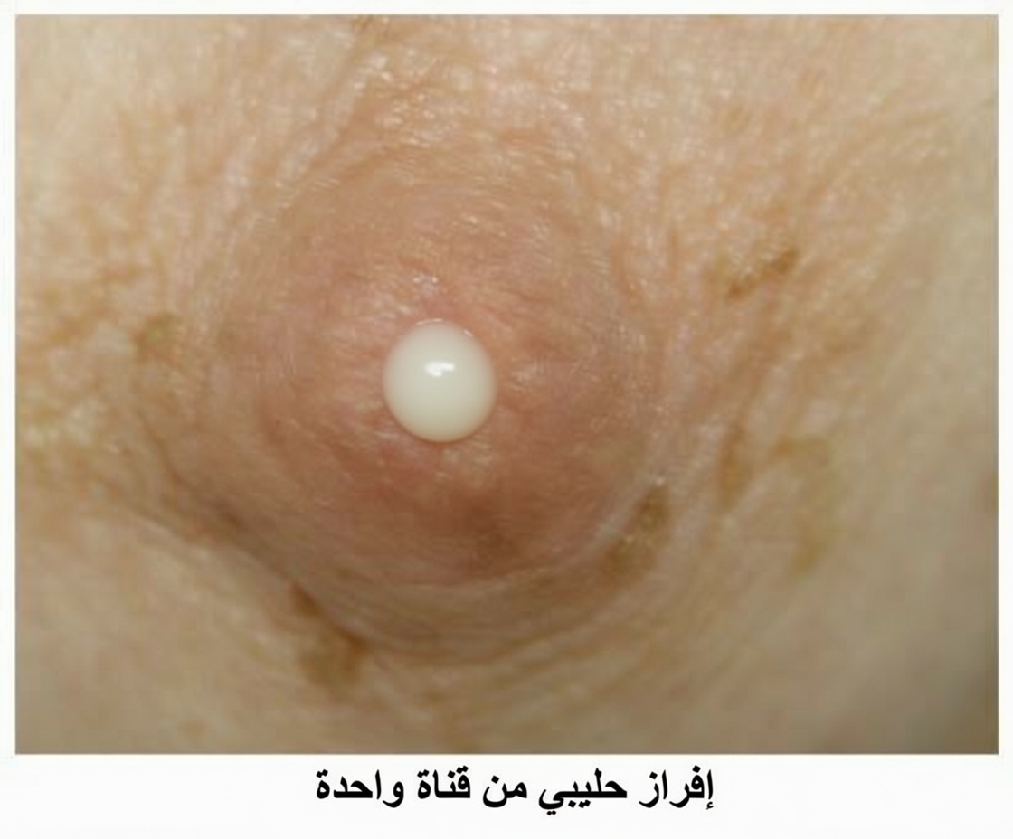 10 علامات تحذيرية لسرطان الثدي: الكشف المبكر قد ينقذ حياتك