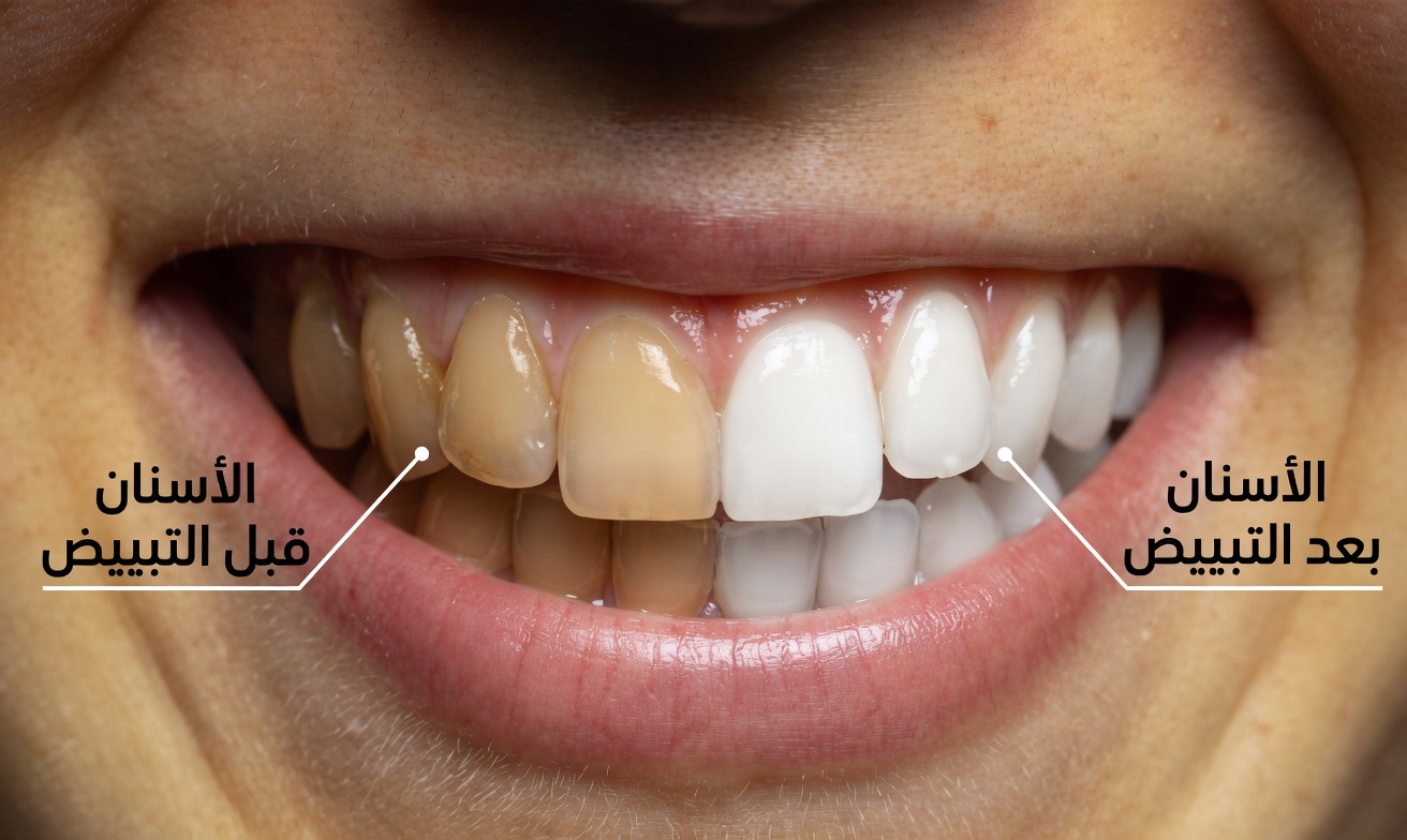 هل تلطخ قهوتك الصباحية أسنانك؟ إليك ما يمكنك فعله حيال ذلك