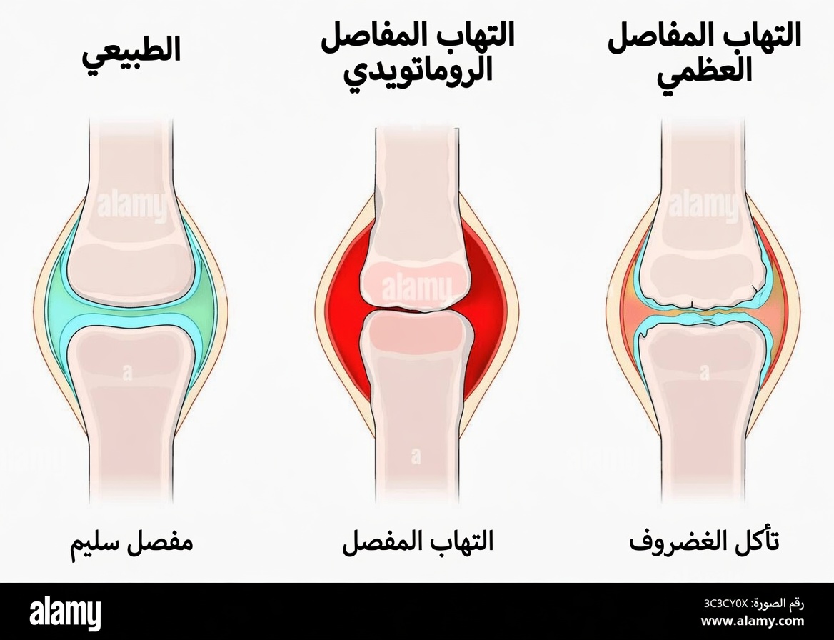 راحة سريعة! هذا سيخفف آلام المفاصل بشكل طبيعي