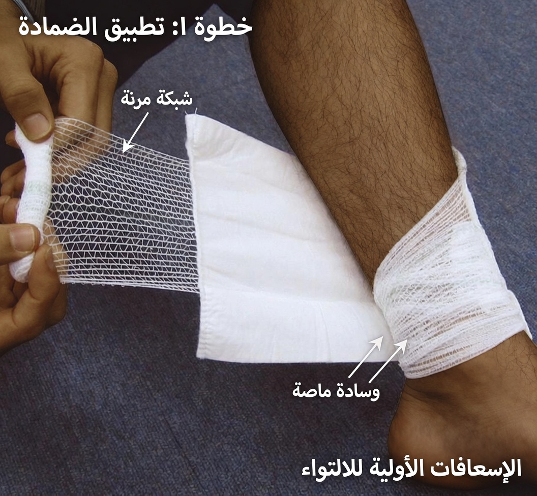 قرحة مؤلمة ذات مركز داكن على ربلة الساق: إنذار جلدي لا ينبغي تجاهله