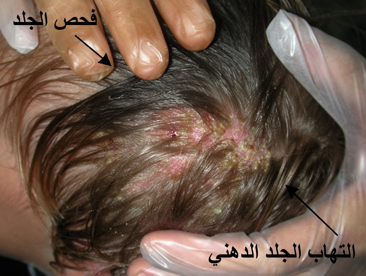 حلقات حمراء على فروة رأس طفلك مع تكسّر الشعر؟ إرشادات أساسية للوالدين