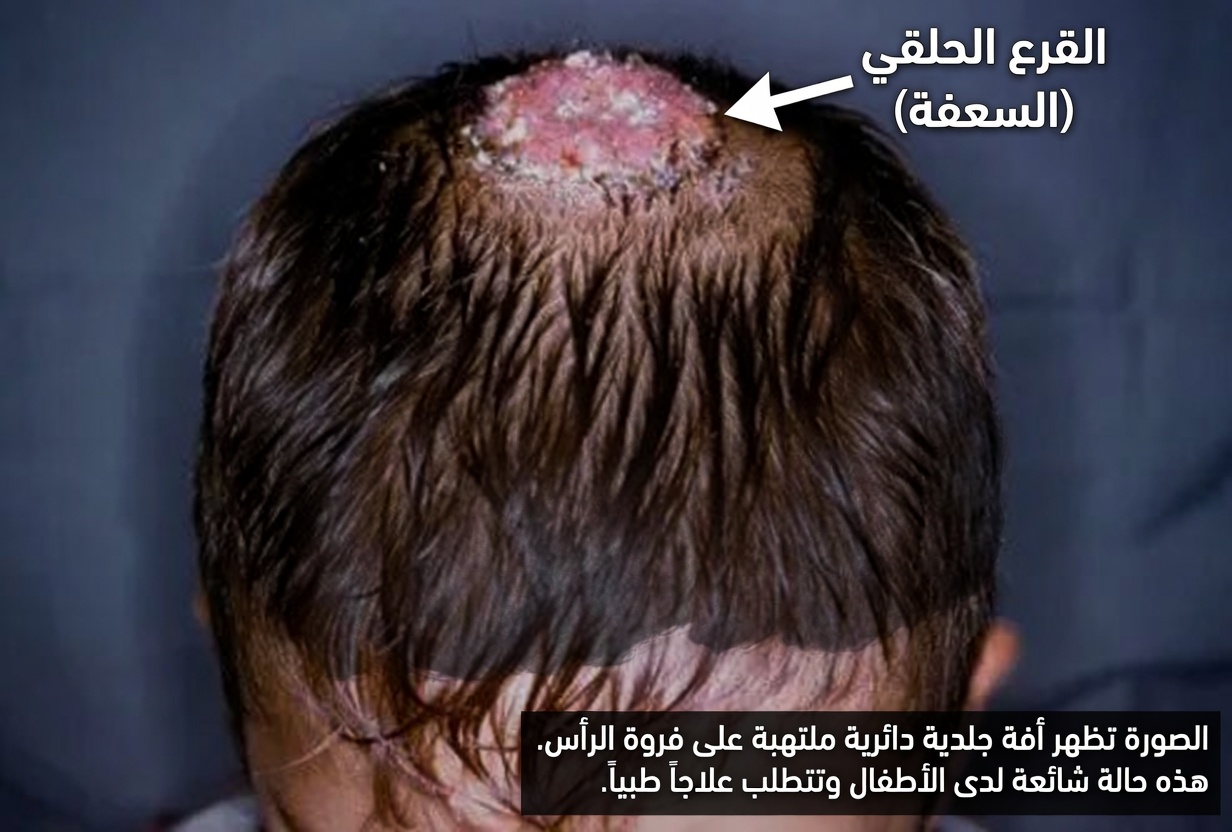 حلقات حمراء على فروة رأس طفلك مع تكسّر الشعر؟ إرشادات أساسية للوالدين