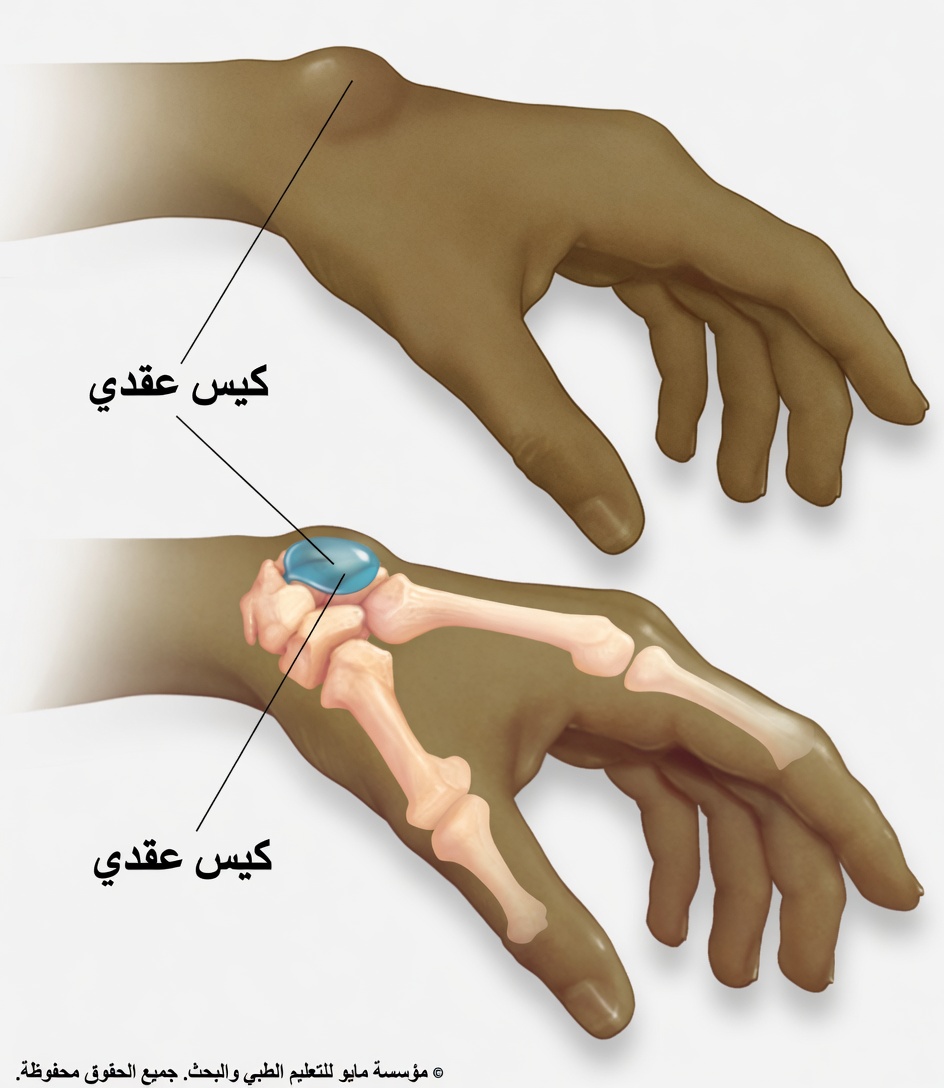 كتلة غريبة على المعصم بين ليلة وضحاها؟ ما الذي ينبغي لكبار السن معرفته