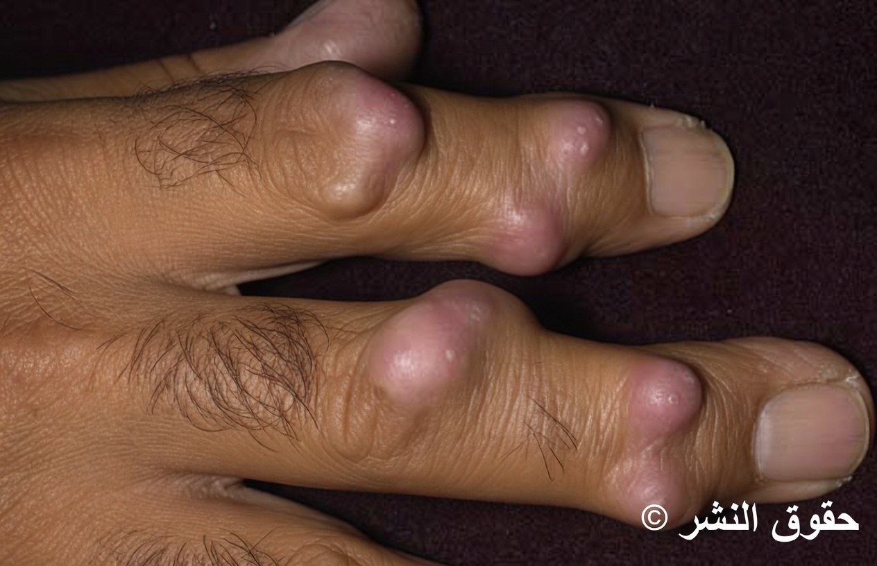 كتلة غريبة على المعصم بين ليلة وضحاها؟ ما الذي ينبغي لكبار السن معرفته