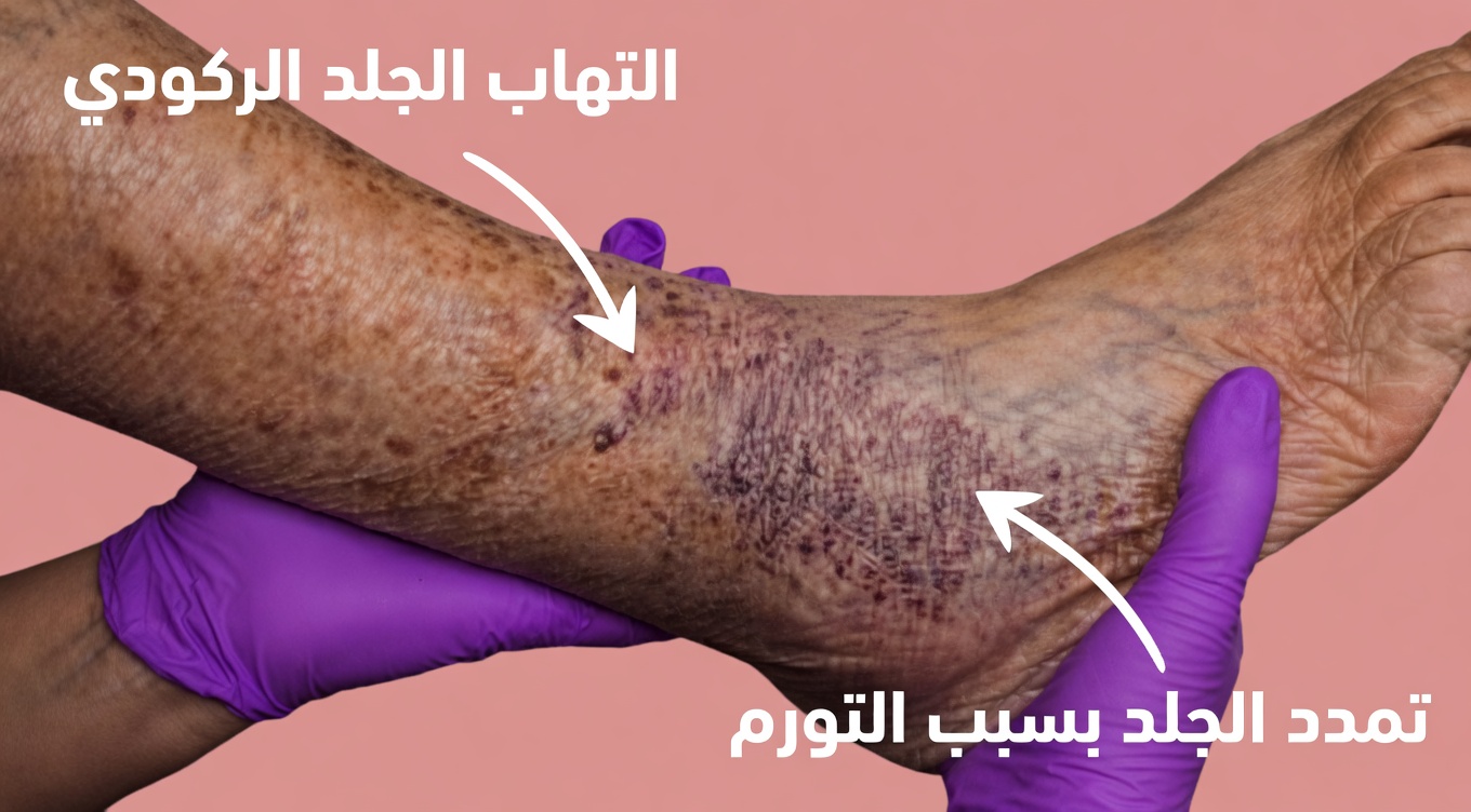 نساء فوق سن الستين: 10 علامات في الساقين قد تشير إلى خطر محتمل للإصابة بالسكتة الدماغية – ما الذي يجب الانتباه إليه