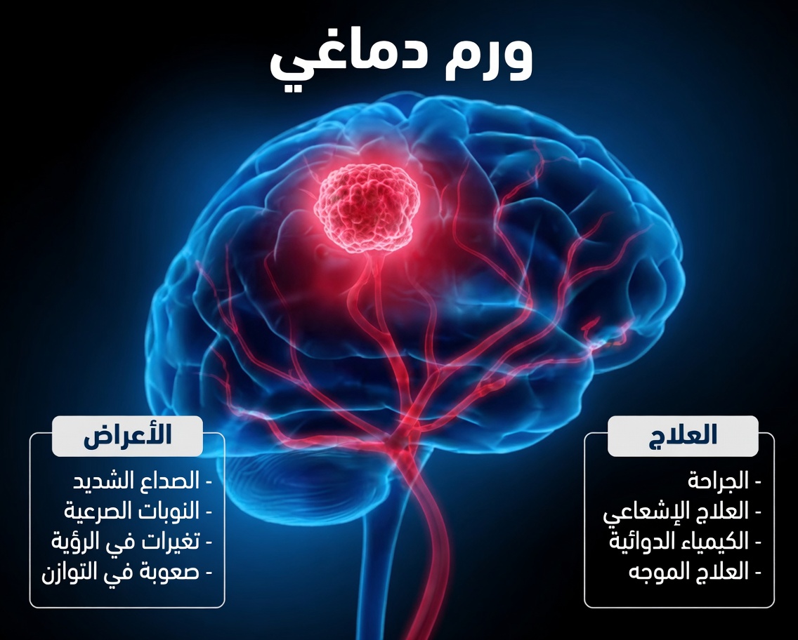 لا تفوّت هذه العلامات التحذيرية الثماني المبكرة لورمٍ في الدماغ – فالتعرّف عليها قد ينقذ حياتك